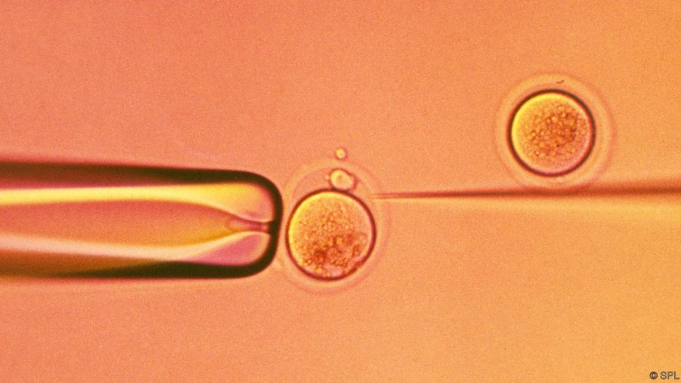 In vitro fertilisation. Light micrograph of a micro-needle (right) that is being used to inject a human sperm cell into a human egg cell. The tip of a micro-pipette (left) is holding the egg cell in place. This in vitro fertilisation (IVF) technique is known as intracytoplasmic sperm injection (ICSI). The injected sperm fertilises the egg and the resulting zygote is then grown in the laboratory until it reaches an early stage of embryonic development. It is then implanted in the patient's uterus, where it develops into a foetus. IVF allows infertile couples to conceive a child.